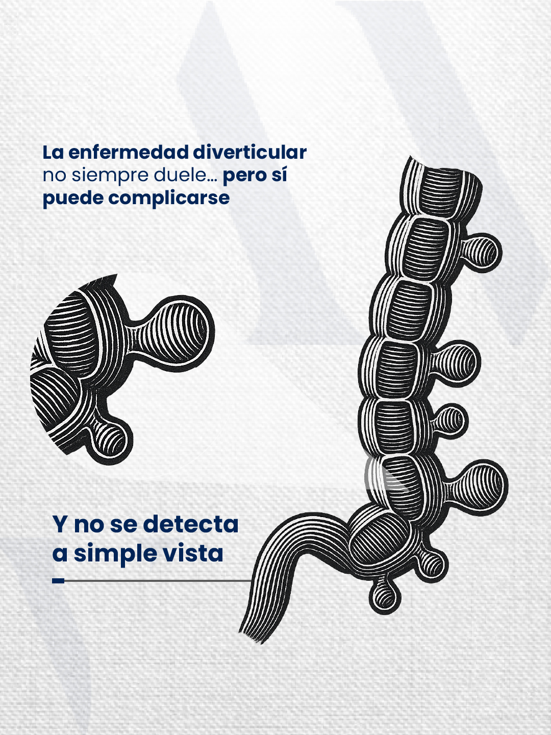 La enfermedad diverticular no siempre duele… pero sí puede complicarse. Y no se detecta a simple vista.
