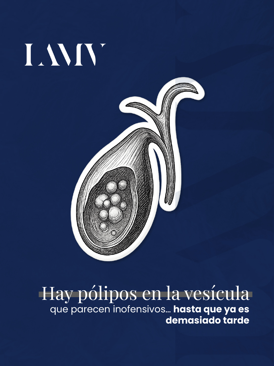 Hay pólipos en la vesícula que parecen inofensivos… hasta que ya es demasiado tarde.